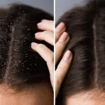 Frequent Dandruff Flakes: Improve Scalp Care and Washing