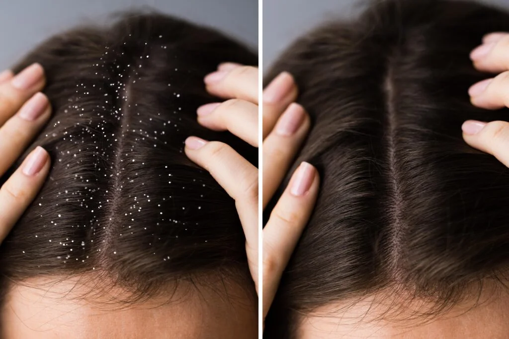 Frequent Dandruff Flakes: Improve Scalp Care and Washing